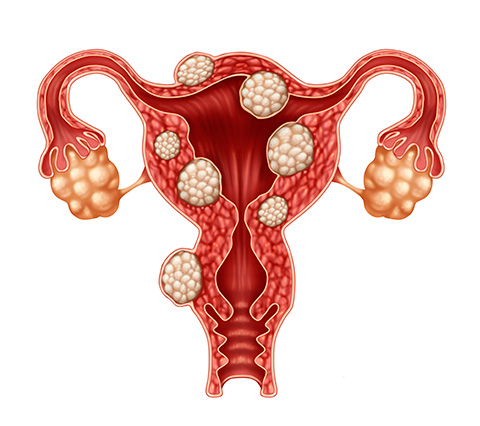 Miomectoma uterina en Bogot, imagen de miomas en el tero